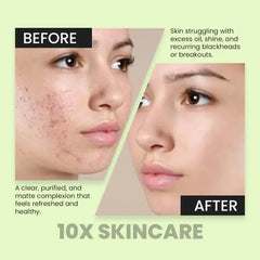 10X Acne Out Face Wash Gel with Salicylic Acid & Tea Tree Deep Pore Cleanser for Acne, Oil Control & Clear Skin (130ml) 10X Skin Care