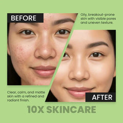 Acne Defence Serum by 10X Skincare Oil Control, Pore Minimizing & Anti Acne Formula for Clear Skin (30ml 10X Skin Care